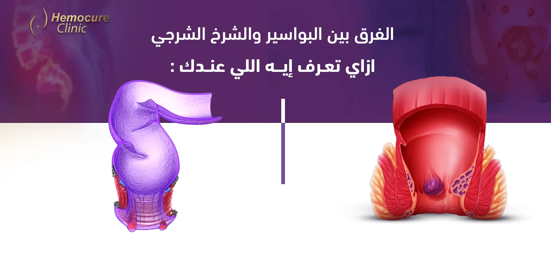 الفرق بين البواسير والشرخ الشرجي: إزاي تعرف إيه اللي عندك؟