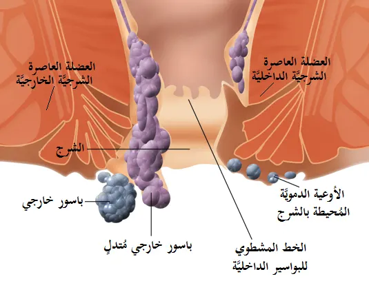 External hemorrhoids: symptoms and appearance