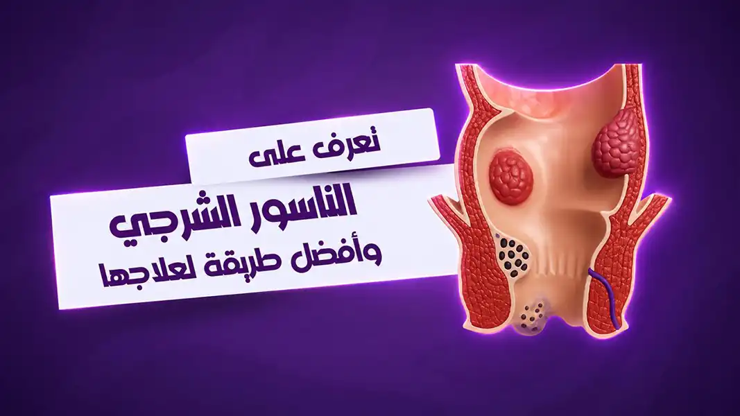سعر عملية الناسور الشرجي بالليزر في مصر 2026