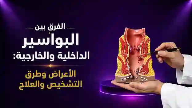 الفرق بين البواسير الداخلية والخارجية: الأعراض وطرق التشخيص والعلاج
