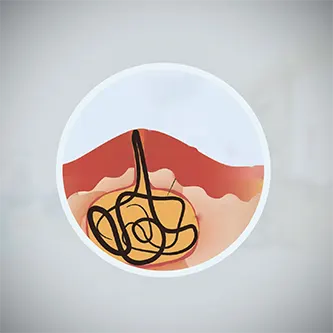 الناسور العصعصي