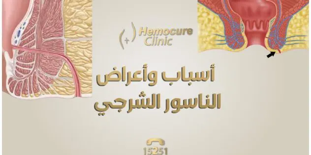 What is an Anal Fistula?